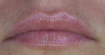 AFTER JUVEDERM